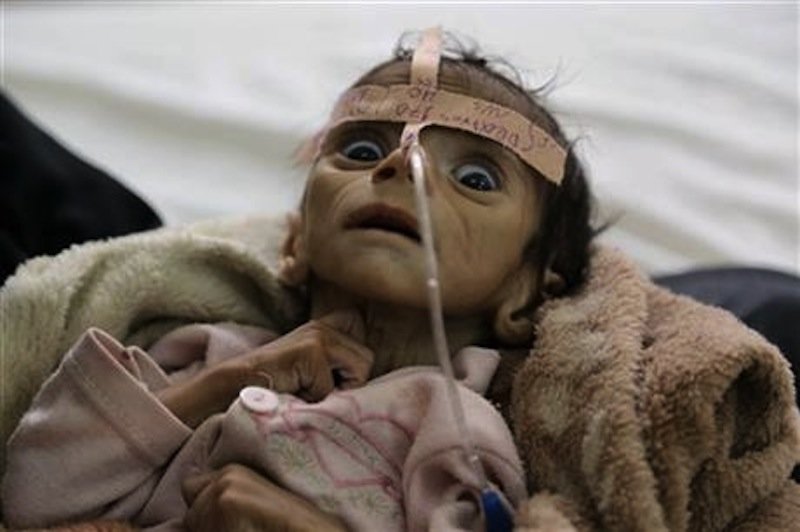 Starving children Yemen