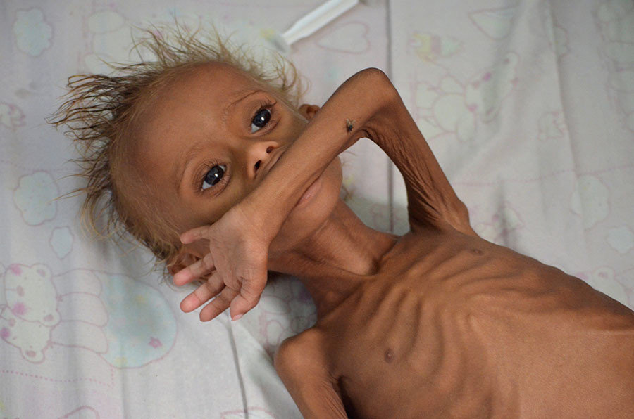 starving yemen children